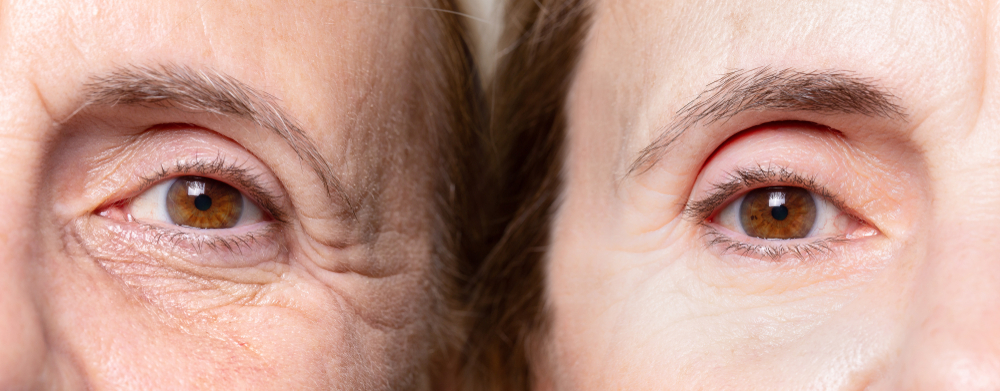 Before and after close-up of an eye showing reduced crow's feet from Botox in Dearborn at Renewal Family Dental.