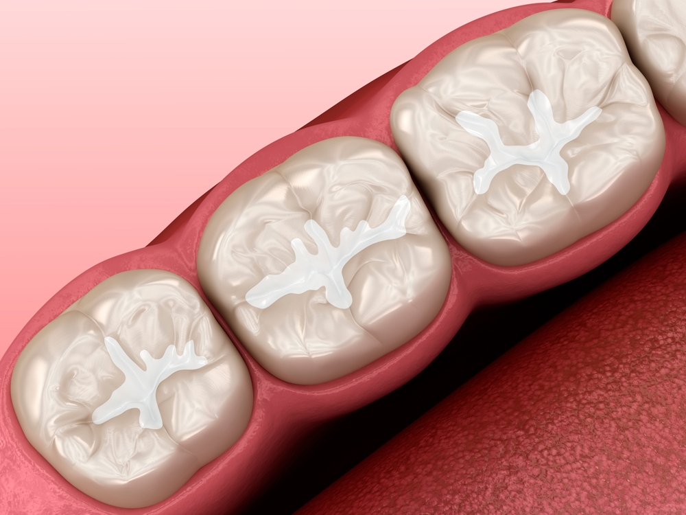 Close-up of molars with dental sealants, representing Preventative Dentistry in Dearborn at Renewal Family Dental.