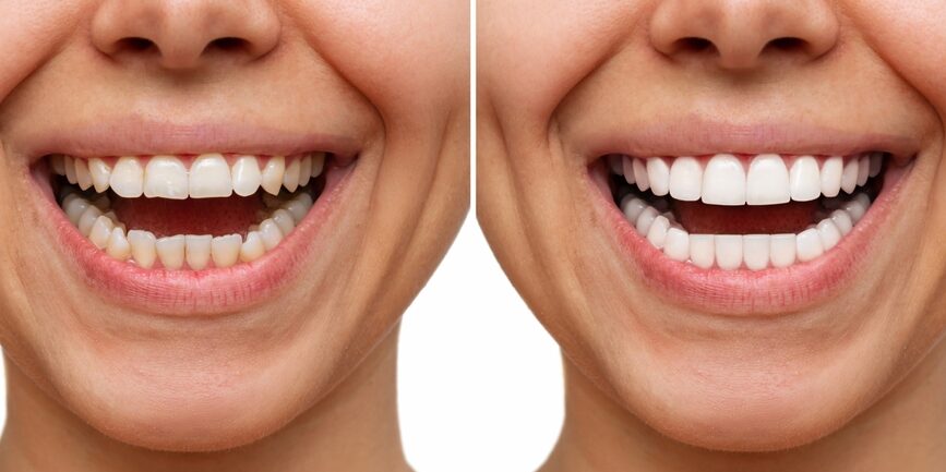 Before and after close-up of a person's smile showing whitened teeth from Our Services at Renewal Family Dental.