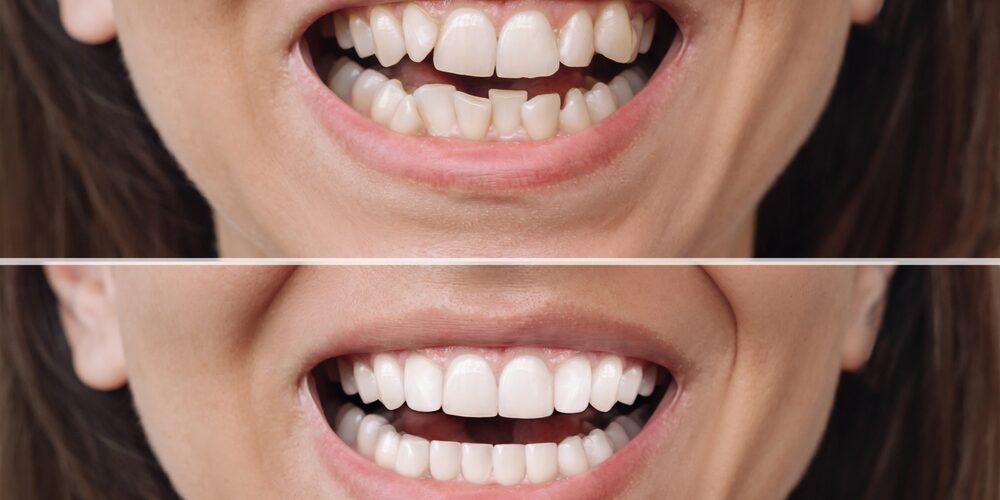 Before and after close-up of a person's smile showing significant dental improvements from Our Services at Renewal Family Dental.