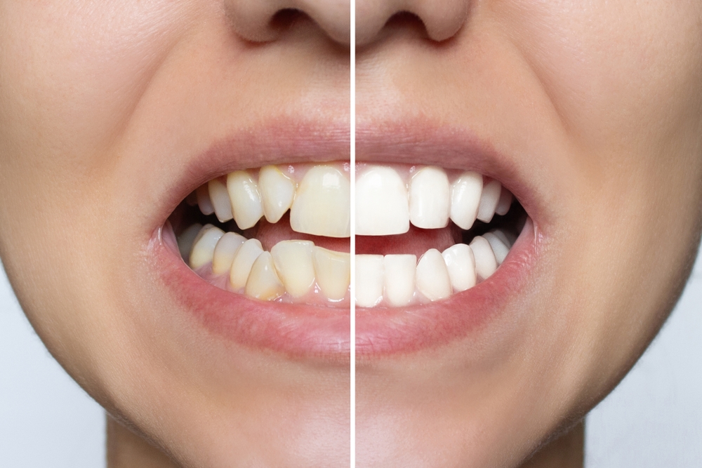 Before and after close-up of teeth showing significant whitening achieved through Our Services at Renewal Family Dental