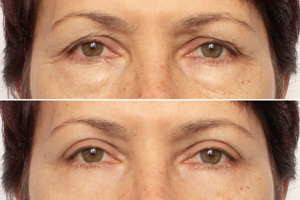 Before and after close-up of eyes showing reduced wrinkles from Botox in Dearborn at Renewal Family Dental.