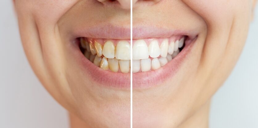 Before and after split image of a smiling person's teeth, showing whitening results from Our Services at Renewal Family Dental.
