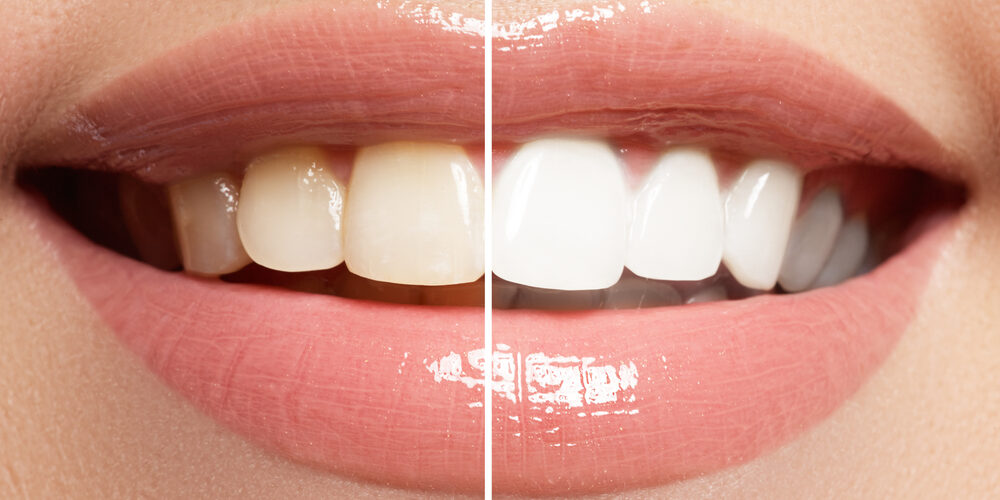 Close-up, before and after split of teeth whitening, showcasing Our Services at Renewal Family Dental.