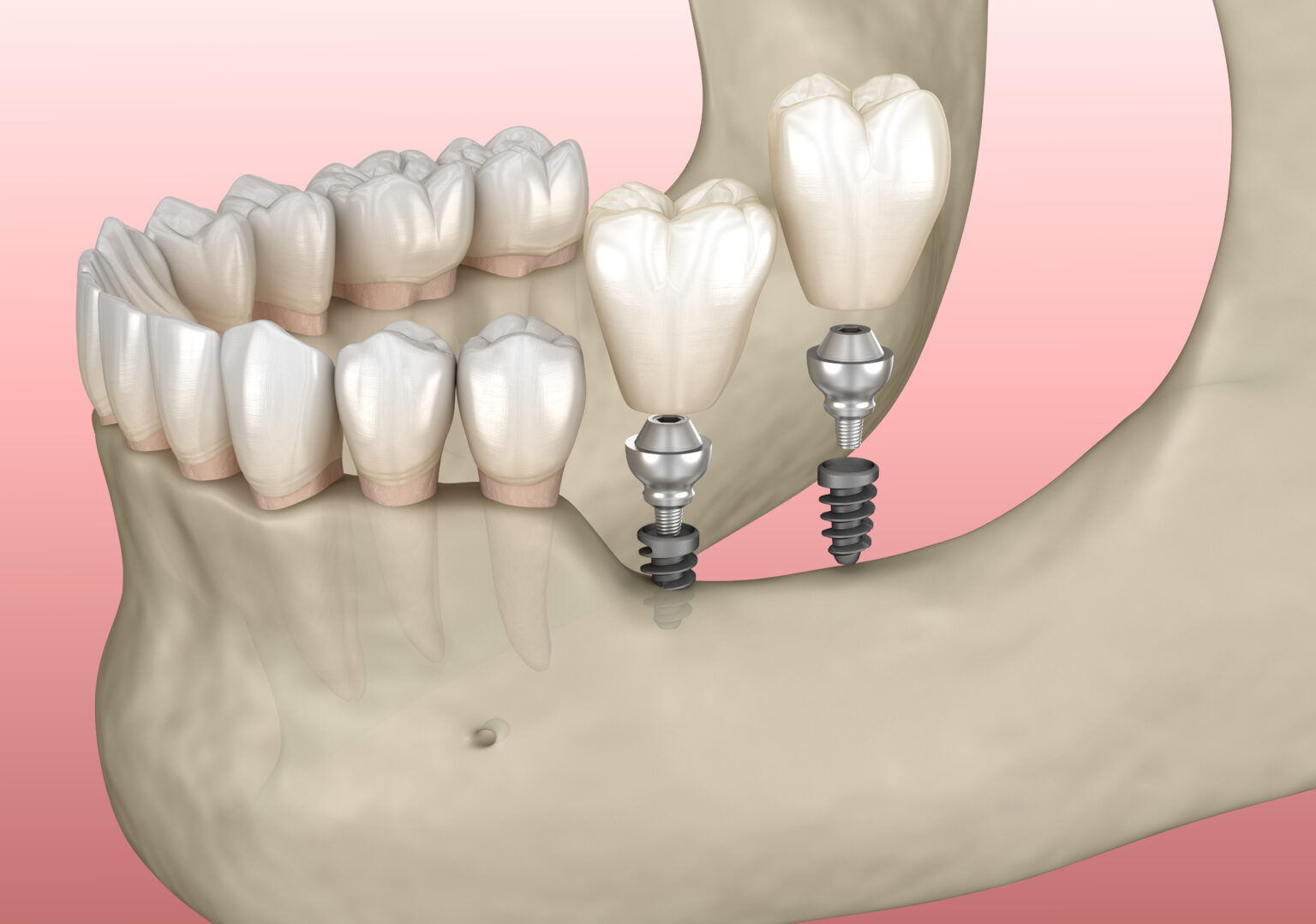 Dental Implants Dearborn