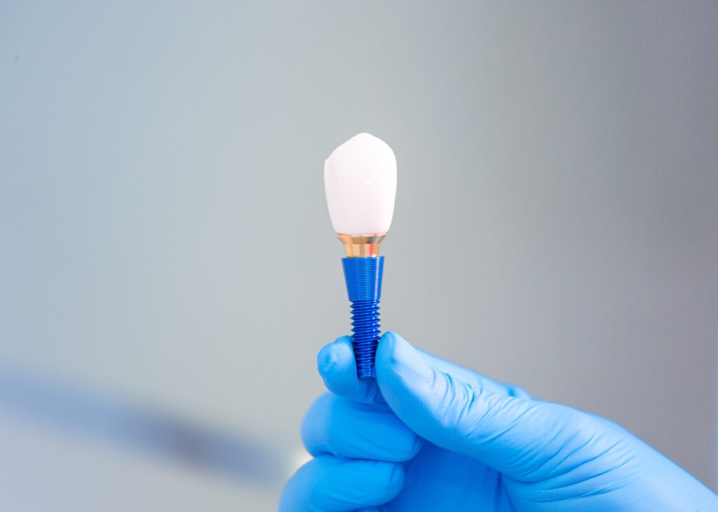 Implant Restorations Dearborn